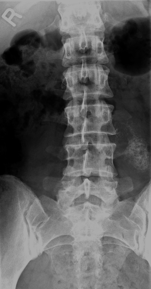 bone-tumours-and-benign-lytic-lesions